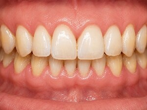 Gum Comfort