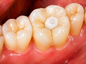 Sensitive Tooth Care