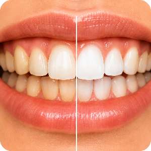 Teeth Staining