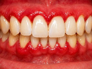 Inflamed Gums